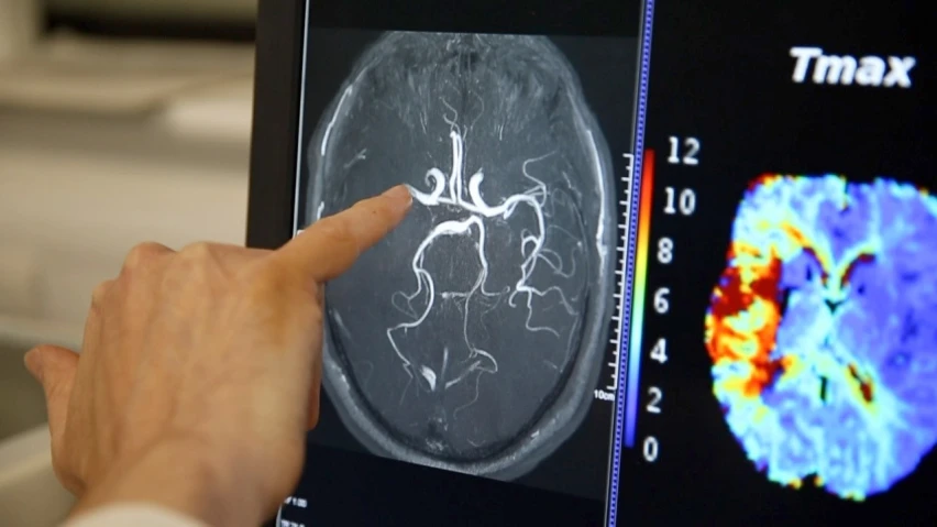 brain-scan-stroke-association-listing.jpg